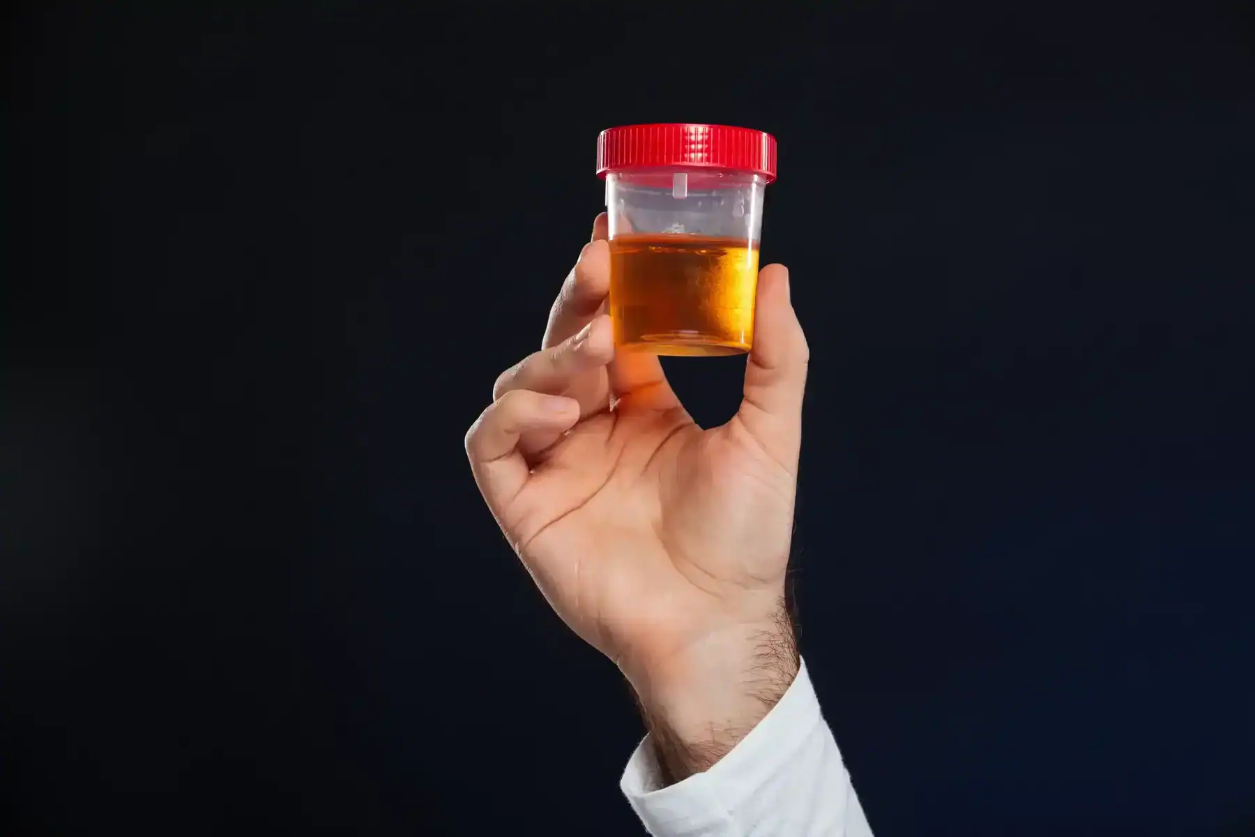 Avaliação de xixi com sangue em Brasília - Dr. Carlos Biojone